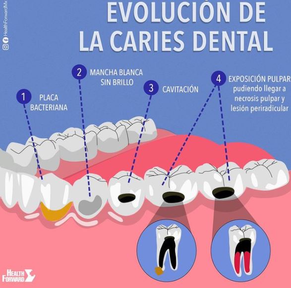 odontologosmx's tweet photo. La caries dental es un trastorno muy común. Con mucha frecuencia ocurre en los niños y en los adultos jóvenes, pero puede afectar a cualquier persona. Es una causa común de pérdida de los dientes en las personas más jóvenes. https://t.co/DOURVENjbY