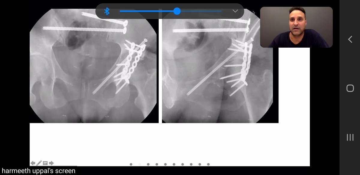 davidhcmd's tweet photo. Someone skipped YouTube Kids Baby Shark along with her bedtime to join Zoom @otatrauma Fracture Night.

We both get excited looking at nice reductions 💪🏾

Thanks to Dr. Uppal for highlight 2 great cases and teaching points!
#Aisforanatomicrestoration https://t.co/gvK0j9iwEw