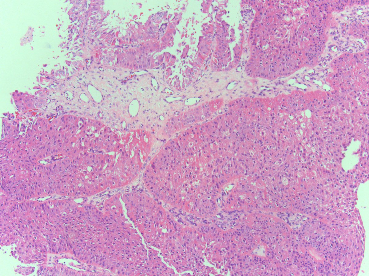 Kathleen Montone (@ktmontone) on Twitter photo Funny looking "sinonasal papilloma-like" sinonasal proliferation? Don't forget to consider a DEK translocated sinonasal carcinoma. Rooper LM, et al A Am J Surg Pathol. 2021; Kuo YJ, et al Mod Pathol. 2021 <a href="/ENTpathology/">J. Bish</a> <a href="/LisaRooperMD/">Lisa Rooper</a> <a href="/aakasharmand/">Zubair Baloch</a> <a href="/NAdappaMD/">Nithin Adappa</a> <a href="/Penn_ENT/">Penn Otorhinolaryngology</a> <a href="/feldmanm30/">Michael Feldman</a> Funny looking "sinonasal papilloma-like" sinonasal proliferation? Don't forget to consider a DEK translocated sinonasal carcinoma. Rooper LM, et al A Am J Surg Pathol. 2021; Kuo YJ, et al Mod Pathol. 2021 <a href="/ENTpathology/">J. Bish</a> <a href="/LisaRooperMD/">Lisa Rooper</a> <a href="/aakasharmand/">Zubair Baloch</a> <a href="/NAdappaMD/">Nithin Adappa</a> <a href="/Penn_ENT/">Penn Otorhinolaryngology</a> <a href="/feldmanm30/">Michael Feldman</a>