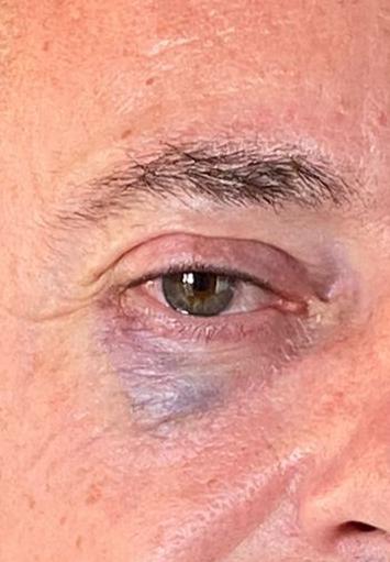 tu_abandono's tweet image. #ULTIMAHORA | AGRESIÓN PUERTO 2

🚨 Interno de Aislamiento Propina PUÑETAZO ojo dcho a 1 f° y a otro FUERTE MORDISCO brazo izq

👉 Los F°s Requieren Asistencia 🏥 en Centro y 🏨

🔥 La @IIPPGob y @interiorgob por la CRIMINALIZACIÓN del Colectivo son RESPONSABLES DIRECTOS

#TAMPM