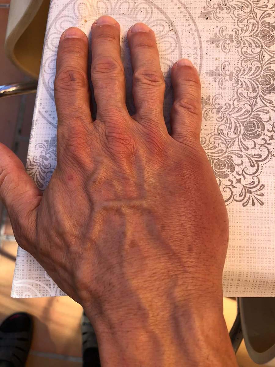 tu_abandono's tweet image. #ULTIMAHORA | AGRESIÓN PUERTO 2

🚨 Interno de Aislamiento Propina PUÑETAZO ojo dcho a 1 f° y a otro FUERTE MORDISCO brazo izq

👉 Los F°s Requieren Asistencia 🏥 en Centro y 🏨

🔥 La @IIPPGob y @interiorgob por la CRIMINALIZACIÓN del Colectivo son RESPONSABLES DIRECTOS

#TAMPM