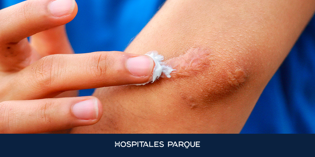 HospitalParque's tweet photo. ¿Dónde se producen los #queloides?

Pueden aparecer en casi cualquier parte del #cuerpo y llegar a medir hasta más de 30 cm 🧑‍⚕️

Los #lugares más comunes son: #nariz, #pecho, #cara y #orejas 🏥

Mucho más ➡️ https://t.co/BG6gOEDhWp https://t.co/7hPScoj6PI
