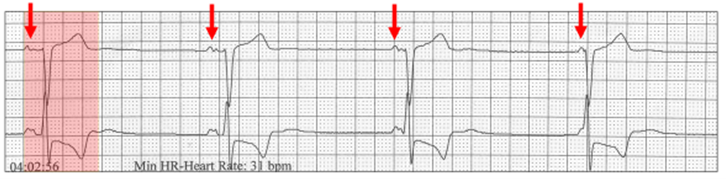 cardioscanUK's tweet photo. Vagal #Hypertonia is a topic that is often confusing and misunderstood, and although we have touched on it briefly in the past, Dr Harry Mond delves a little deeper in a bid to clear up any confusion. Read more: https://t.co/Q2HTIvBG5v #ECG #epeeps #cardiology https://t.co/p8gXuv2J8x