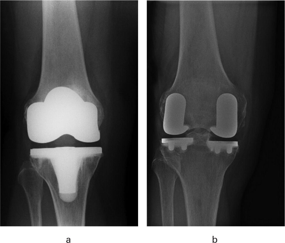 Robotic arm-assisted bi-UKA has a similar safety profile to traditional mechanically-aligned TKA surgery over the first postoperative year ow.ly/EFvk50Gmtim

#Arthroplasty #Robotics <a href="/GriOrtho/">Ortho-GRI</a> <a href="/MatthewBanger/">Matthew Banger</a> <a href="/DoonanJames/">James Doonan</a>