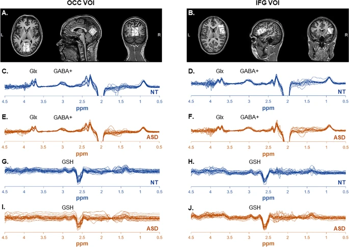 Prediction learning in adults with autism and its molecular correlates @LaurieAnne_ST @joke_temmerman @LAuRes_tweet molecularautism.biomedcentral.com/articles/10.11…