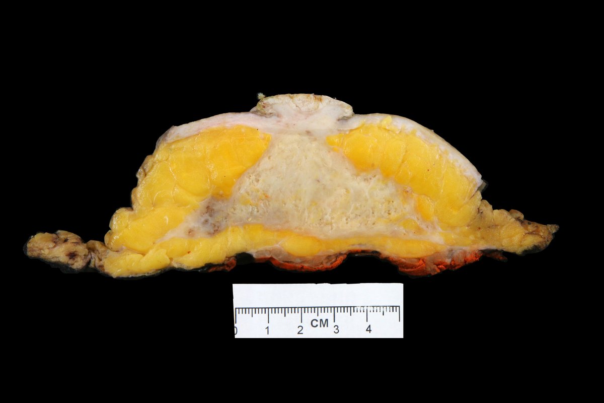 BWHPath's tweet photo. Time for the Gross Case of the Week! This is an extreme presentation of a specimen we see a lot of in the grossing room. Can you name the resection and pathology? #BWHGrossCOTW #PathAssist https://t.co/CIngbbDFIj