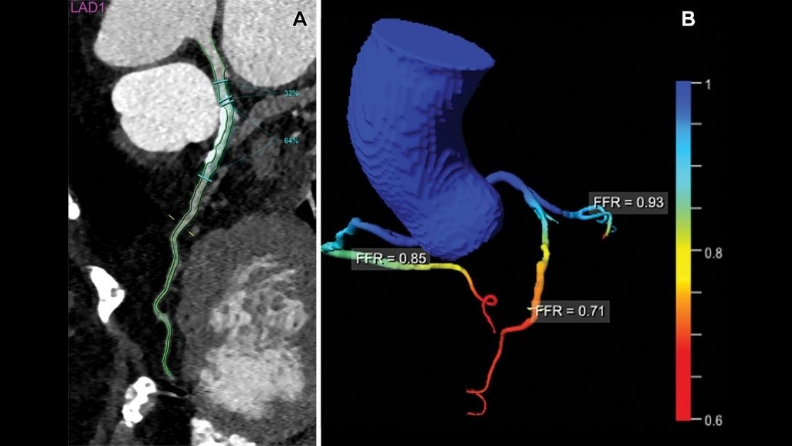 CT fractional flow reserve was associated with major adverse cardiac events in candidates for transcatheter aortic valve replacement. bit.ly/2YeMil4 <a href="/AquinoGilberto1/">Gilberto Aquino</a> <a href="/TilmanEmrich/">Tilman Emrich</a> @basel_yacoub <a href="/chakos/">chakos</a> @burt2021 <a href="/muscradres/">MUSC Radiology Residency</a> <a href="/MUSCcvi/">MUSC Cardiovascular Imaging</a> <a href="/MUSChealth/">MUSC Health</a>