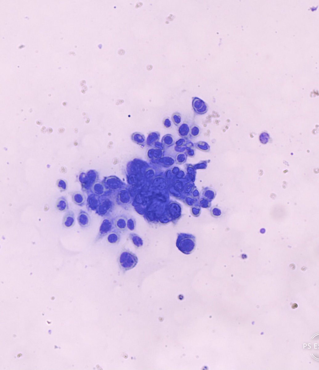 Herpes simple . Tzanck : células acantoliticas y sincitio herpetico