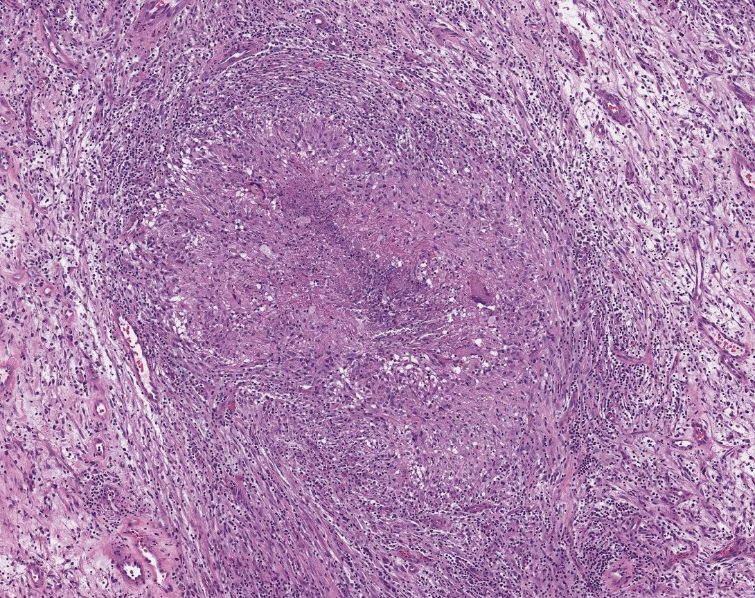 UNDER YOUR MICROSCOPE: An 82-year-old man with a right frontal rim-enhancing lesion. #neuropath WSI: image.upmc.edu:8080/NeuroPathology…. Read the full case here: onlinelibrary.wiley.com/doi/10.1111/bp…