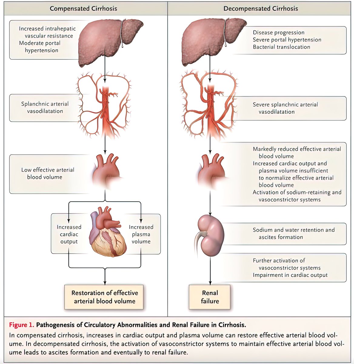 Circulatory dysfunction in compensated 🆚 decompensated cirrhosis #LiverTwitter #4KMedEd

(Courtesy of <a href="/NEJM/">NEJM</a>)