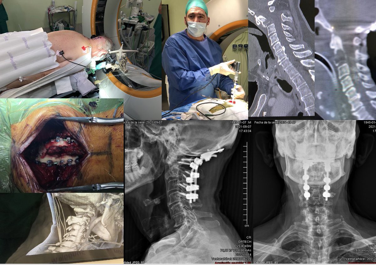 DrParajon's tweet photo. #3dnavigation is not only useful for screws.
It was used in this case for
- intraoperative assesment of the reduction
- screws insertion
- tumor biopsy guidance.
#myeloma was diagnosed and the patient underwent #RT https://t.co/5jJM8HLmY9