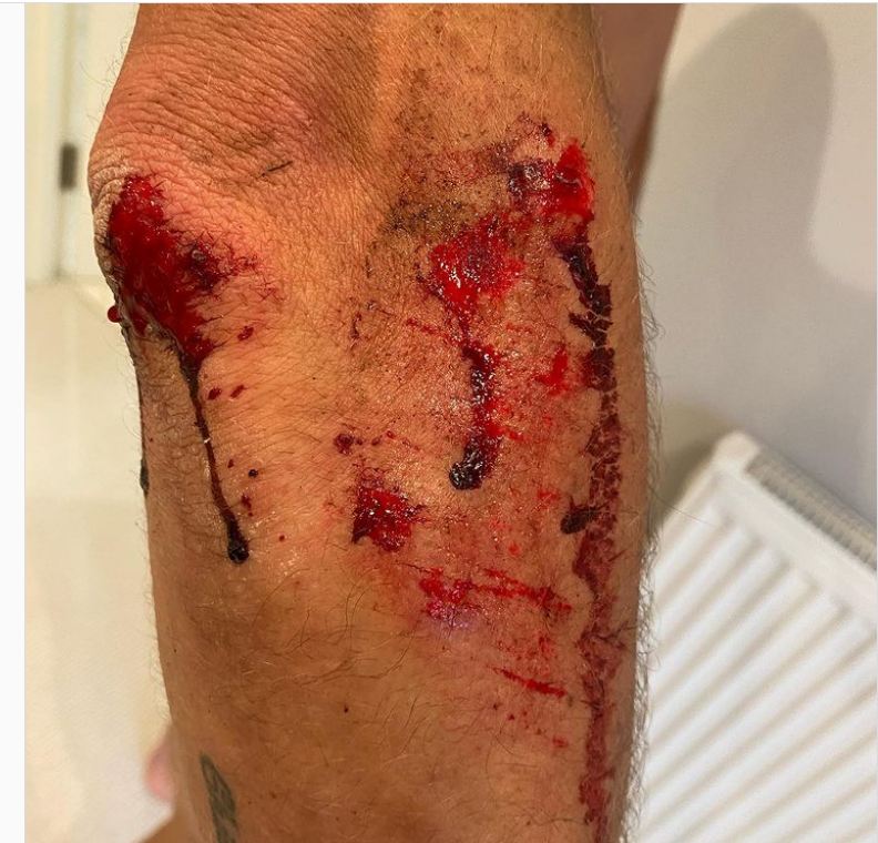 Shocking story from <a href="/AlexandarRicha2/">Alexandar Richardson</a> about being robbed by thugs on motorbikes with a machete in Richmond Park, London ...   where are the police/rangers for this park? Is no one safe these days in such places... Heal quick Alex. So so sad ...
