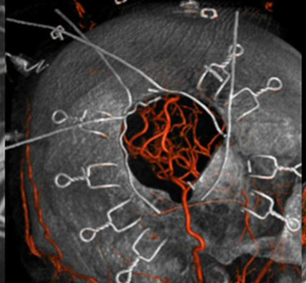On October 14th Cerebrovascular Symposium on #moyamoya directed by <a href="/ENossek/">Erez Nossek</a> one day in-depth program on a complex and challenging problem, led by <a href="/nyulangone/">NYU Langone Health</a> and guest field leaders.  For info:
med.nyu.edu/education/cont… #MoyamoyaAwareness #MoyamoyaStrong #Stroke