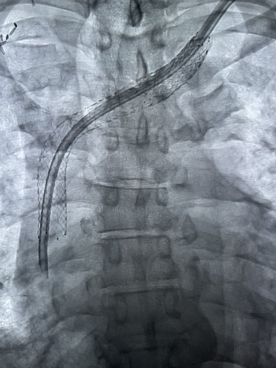 Line holiday for HD patient. Access gone and central occlusion bilaterally. Successful revascularization, trialysis catheter placement and hopefully adequate for left AVF. <a href="/SIR_ECS/">SIR ECS</a> <a href="/SIRRFS/">SIR RFS</a> #irad #vascular #CardioTwitter #nephrology