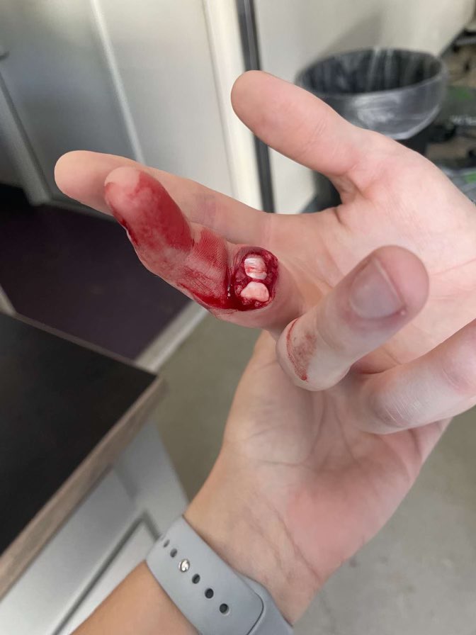 Now this is what I call an open dislocation!! Dem bones…