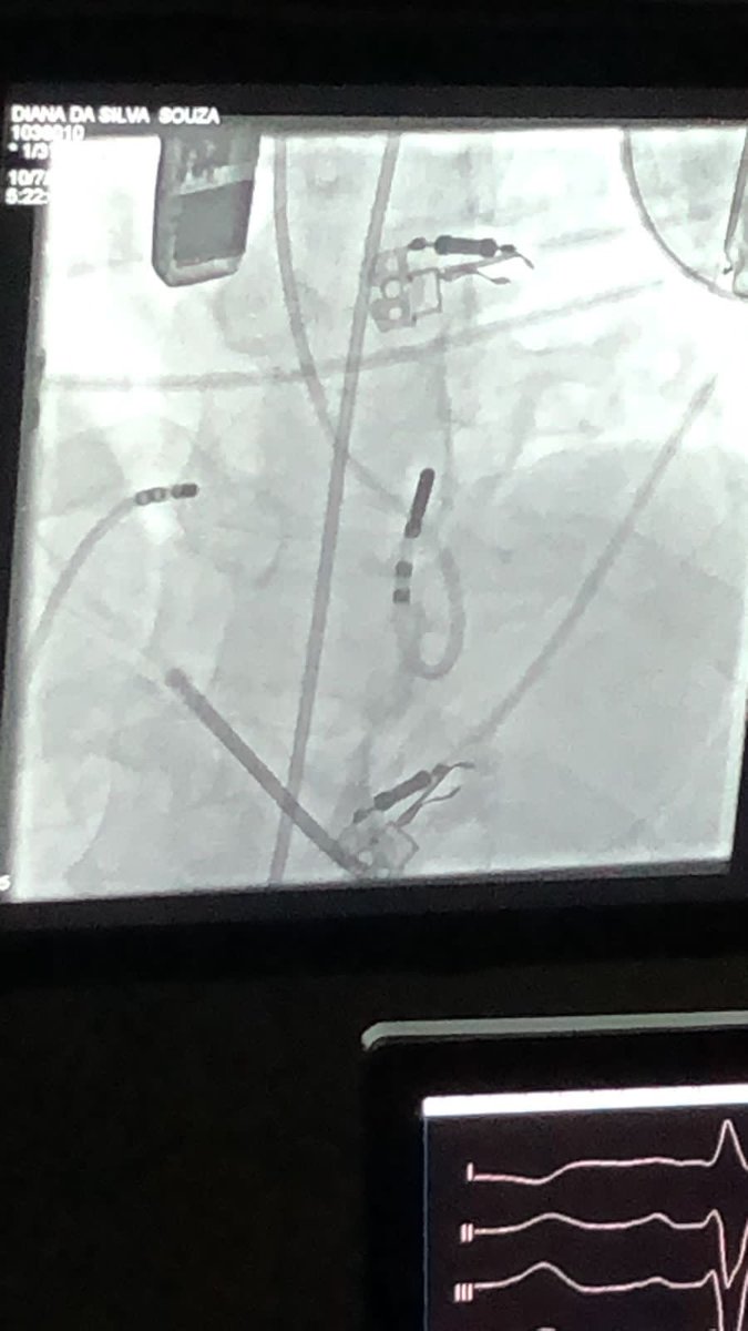 DrBrunoValdigem's tweet photo. 50th Septal ablation of Hypertrophic obstructive cardiomyopathy for gradient reduction! Proud for the achievement. Thanks to all those who came along  @SociedadeRio @SocCardioESP @hrs_journal @ACCmediacenter @jczerpa @DrNilsonAraujo1 @sbc_cientifico @ArquivosSBC https://t.co/24VUI0kP9Y