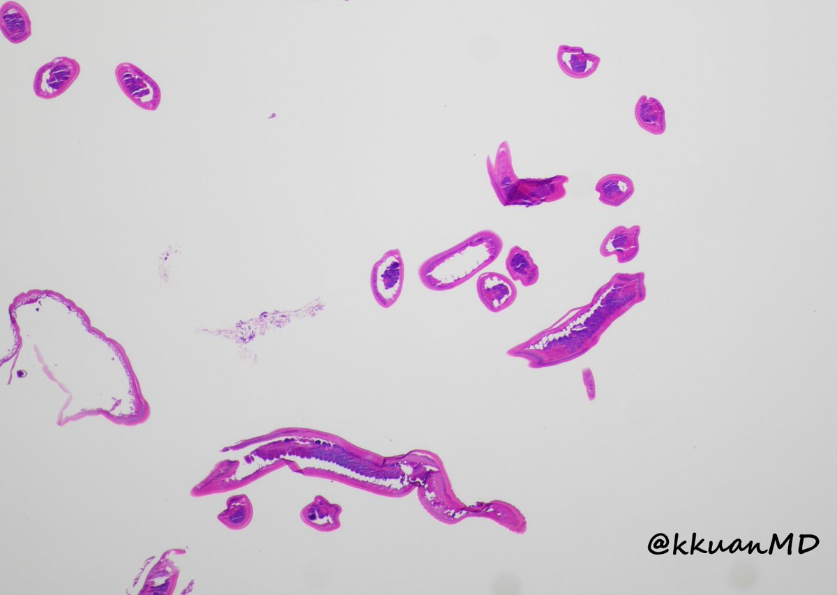 Kevin Kuan (@kkuanmd) on Twitter photo T. Trichiura: unwanted tenants of GI tract. Can you identify the structure? Annotations on subsequent tweets. #pathtwitter #microbiology #GIpath #patheducation #Gastroenterology <a href="/EinsteinPath/">Einstein Montefiore Pathology</a> <a href="/TristanRutland7/">Tristan Rutland MBBS FRCPA IFCAP</a> <a href="/ariella8/">Celina Stayerman MD</a> T. Trichiura: unwanted tenants of GI tract. Can you identify the structure? Annotations on subsequent tweets. #pathtwitter #microbiology #GIpath #patheducation #Gastroenterology <a href="/EinsteinPath/">Einstein Montefiore Pathology</a> <a href="/TristanRutland7/">Tristan Rutland MBBS FRCPA IFCAP</a> <a href="/ariella8/">Celina Stayerman MD</a>