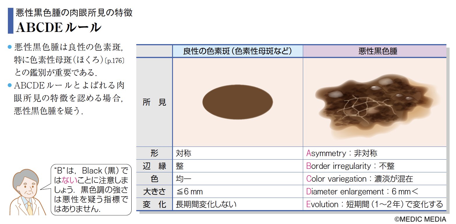 病気がみえる 悪性黒色腫 メラノーマ Abcdeルールとよばれる所見を認める場合 悪性黒色腫を疑う 病みえ14 P 217 T Co Ynlenboq5y T Co Dyy2kek8zj Twitter