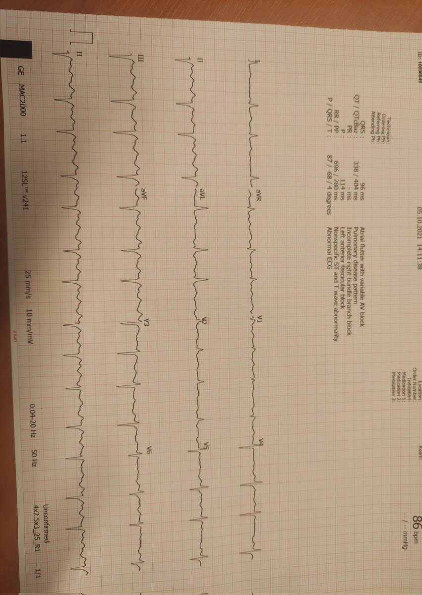 Fatih Mehmet UÇAR (@dr_fatihucar) on Twitter photo 2 times CTI ablation before. Localisation? <a href="/drabdlkdruslu/">Abdulkadir Uslu</a> @drmustafacetin1 <a href="/Hapa_EP/">Kevin Brady</a> <a href="/kamilgulsen/">Kamil Gülşen</a> @drerkanbaysal <a href="/ChristianHeeger/">Christian-H. Heeger</a> 2 times CTI ablation before. Localisation? <a href="/drabdlkdruslu/">Abdulkadir Uslu</a> @drmustafacetin1 <a href="/Hapa_EP/">Kevin Brady</a> <a href="/kamilgulsen/">Kamil Gülşen</a> @drerkanbaysal <a href="/ChristianHeeger/">Christian-H. Heeger</a>