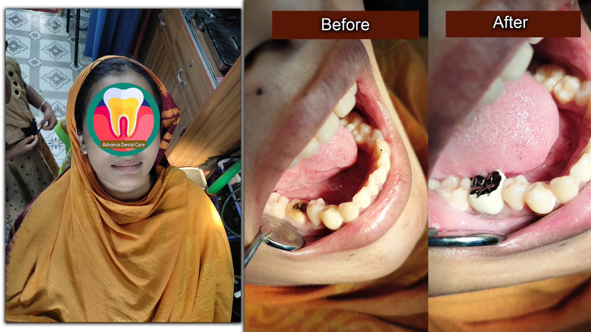 #RCT #dentalcap
#toothcap