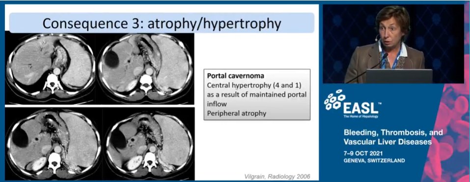 EASLedu's tweet photo. Valérie Vilgrain tackles the tricky topic of deportalisation &amp; its consequences:

1⃣Increased arterial flow
2⃣Begning Regenerative nodules
3⃣Atrophy/hypertrophy complex

Details in pictures🖼️
#EASLmono @EASLnews @VirginiaHdezGea @rautou
@adegottardi https://t.co/ylau5g9lYd
