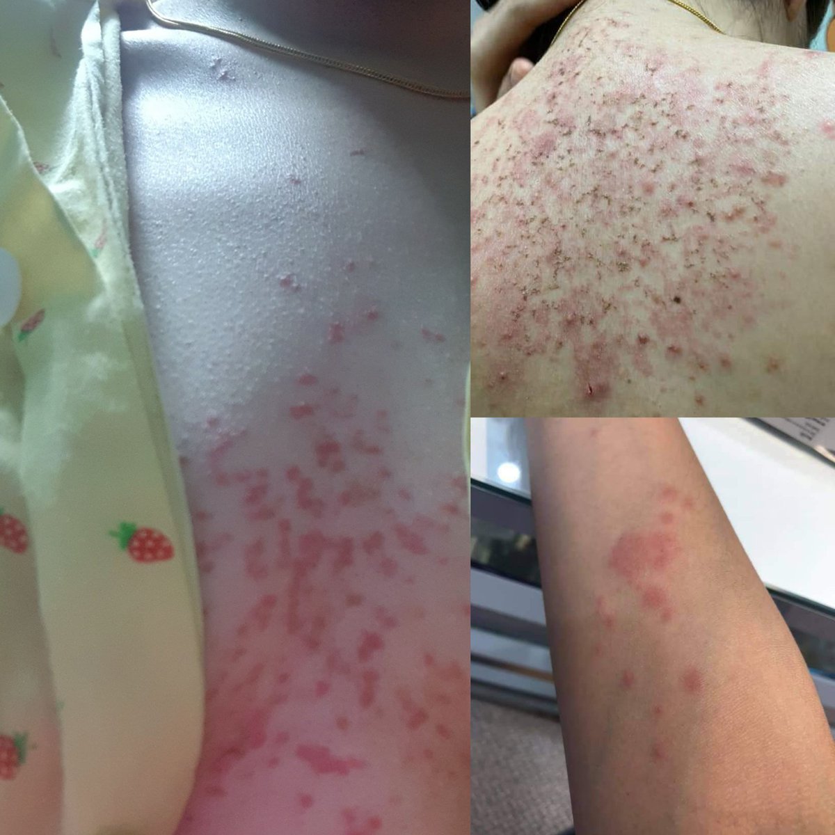 เตือนวัยทำงานในเศรษฐกิจแบบนี้อาจจะบีบให้ต้องรีบพัฒนาตัวเอง แต่อย่าลืมดูแลตัวเองนะ

ระวังเป็น"ภูมิคุ้มกันเป็นพิษ"เพราะทำงานหนักเกินปล่อยให้เครียดสะสม+นอนน้อยติดต่อกันเป็นเดือน

ฮอร์โมนอื่นๆจะรวนทั้งหมดเพราะฮอร์โมนค.เครียดมันสามารถกดฮอร์โมนอื่นๆ,กดภูมิคุ้มกันได้ จนร่างกายประท้วง