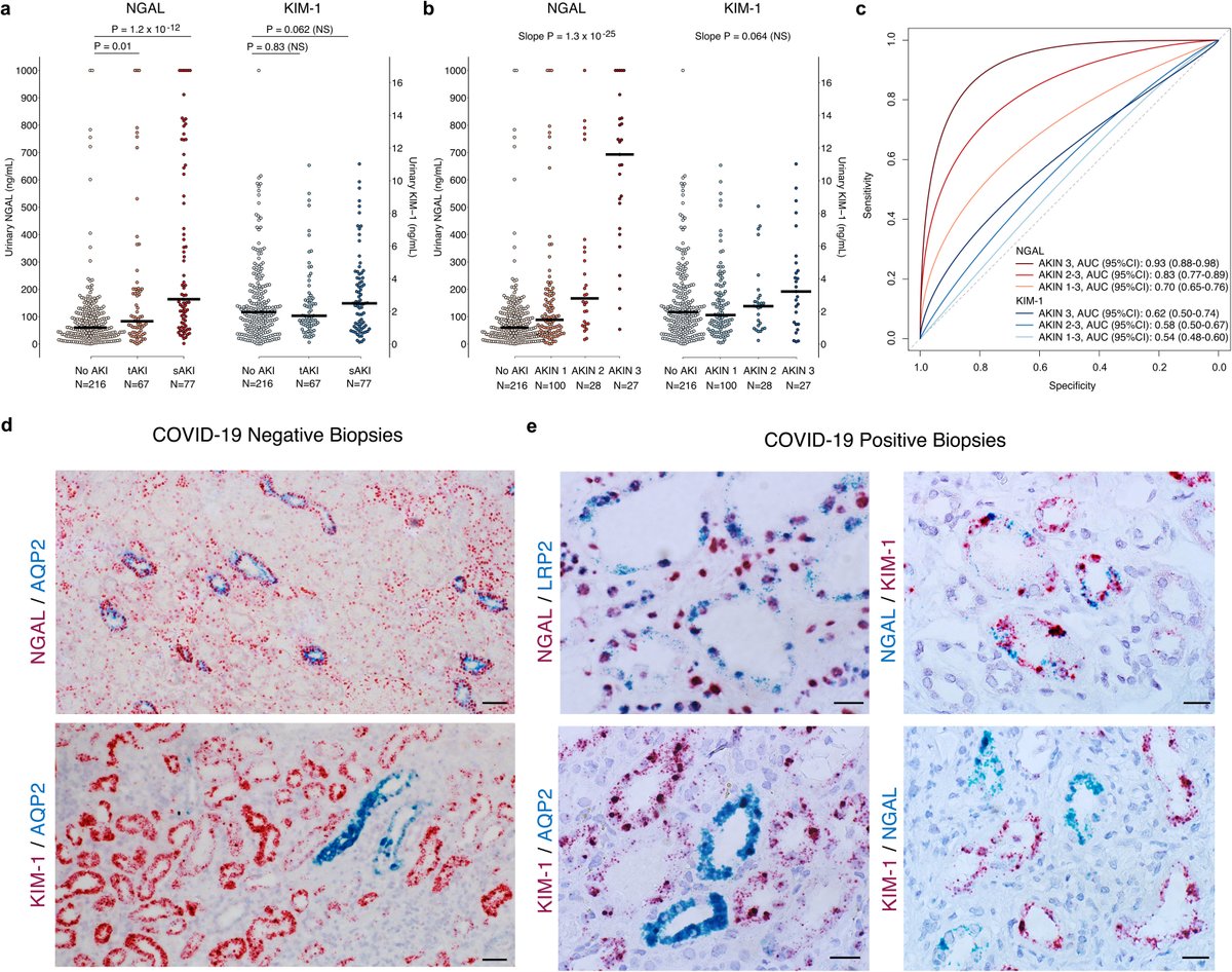 Elevated NGAL is Associated with the Severity of Kidney Injury and Poor Prognosis of Patients with #COVID19. 2021 from <a href="/KIReports/">KIReports</a> @ColumbiaKidney <a href="/SumitMohanMD/">Sumit Mohan</a> @kirylukk

➡️ kireports.org/article/S2468-…