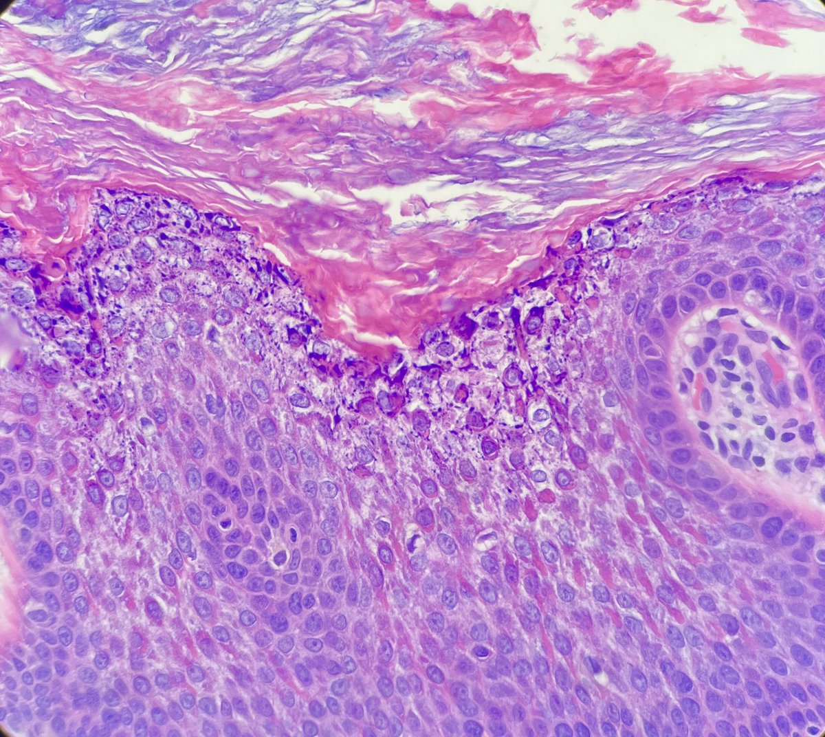 Saw some beautiful epidermolytic hyperkeratosis! Can be incidental, or as part of the epidermolytic acanthoma (more than 50% of the lesion surface generally). On genital sites these can be mistaken for condyloma! #pathspotter Can be multiple or solitary. #dermpath