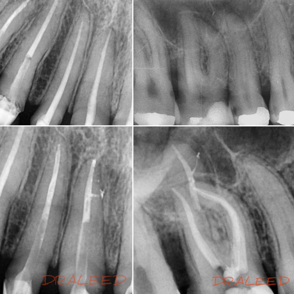 Lateral canals = Ultrasonic + WVC