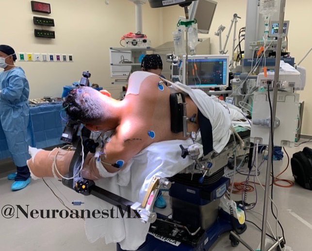 NeuroanestMx's tweet photo. #microvasculardecompression
Male 34 years old. Trigeminal neuralgia V1, right V2.
#tiva Propo-Remi-Lido, #type II monitoring.
Neuromonitoring #bismonitor
Position: Left #parkbench
#neuroanesthesia
#neurosurgery
#teamtiva
#neurotwitter
#medtwitter https://t.co/x10LIiZRR0