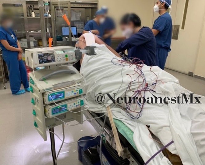 NeuroanestMx's tweet photo. #microvasculardecompression
Male 34 years old. Trigeminal neuralgia V1, right V2.
#tiva Propo-Remi-Lido, #type II monitoring.
Neuromonitoring #bismonitor
Position: Left #parkbench
#neuroanesthesia
#neurosurgery
#teamtiva
#neurotwitter
#medtwitter https://t.co/x10LIiZRR0