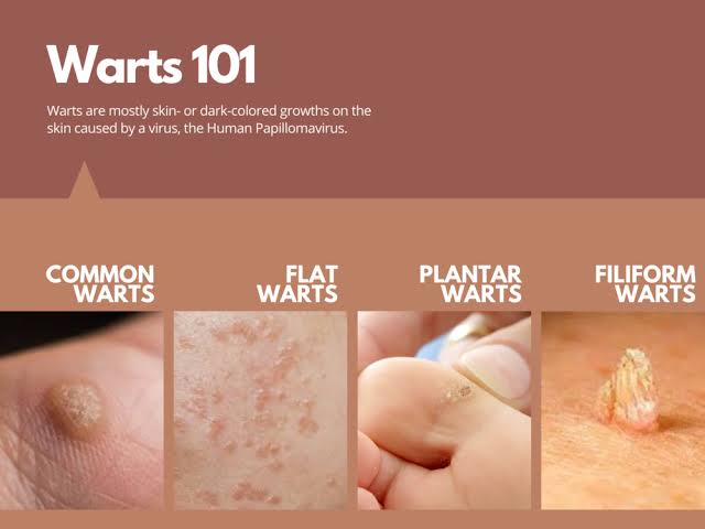 hpv flat warts