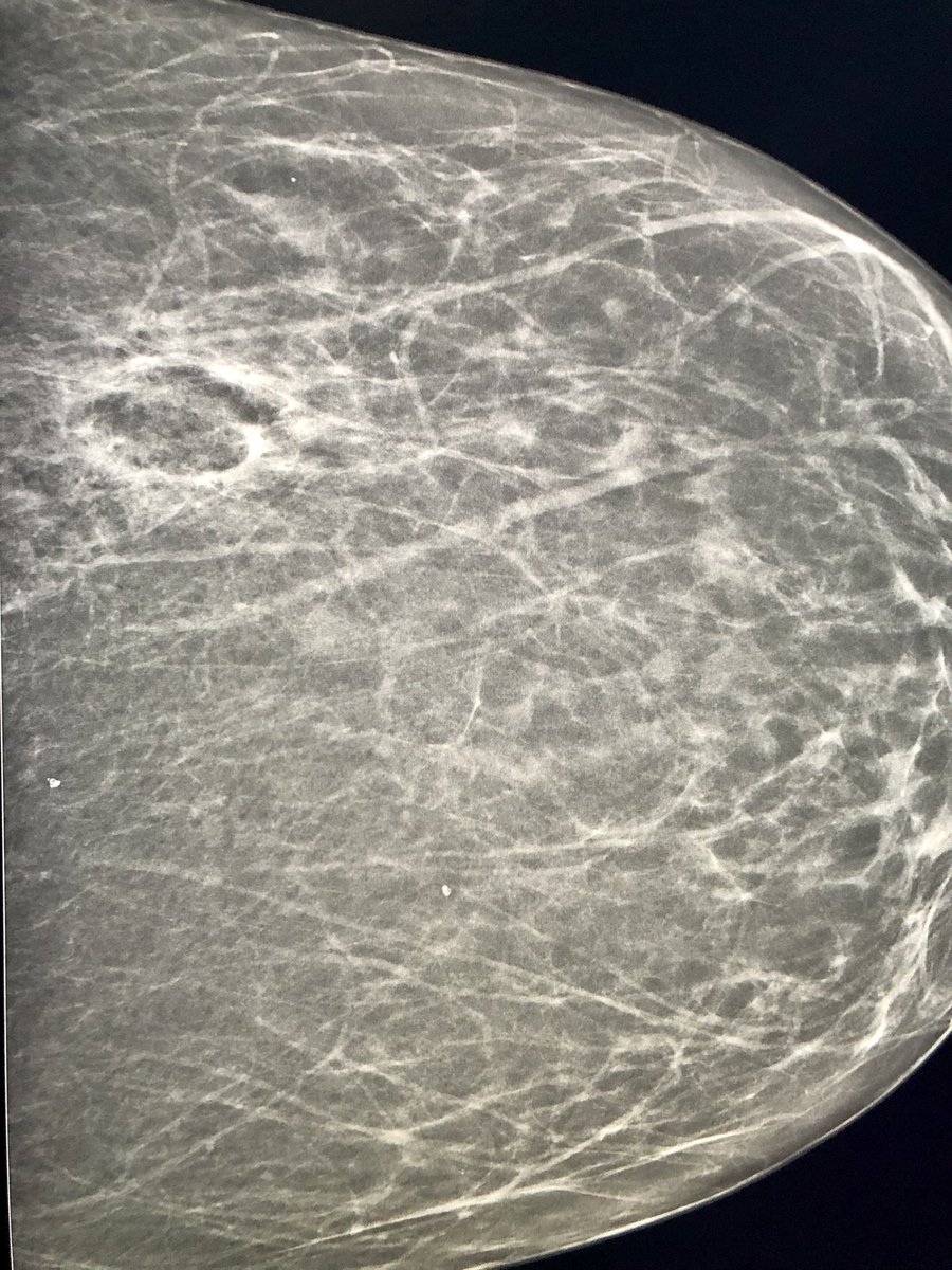 No evidence of residual disease at 1 yr f/u - #IRAd 1st <a href="/NYGH_News/">North York General</a> - Breast CA #Cryoablation 1.6cm IDC, high surgical risk, posted with permission <a href="/CAIRweb/">Canadian Association for Interventional Radiology</a> <a href="/CAIRweb/">Canadian Association for Interventional Radiology</a> <a href="/DrPatKennedy/">Patrick Kennedy</a> #BreastCancerAwarenessMonth