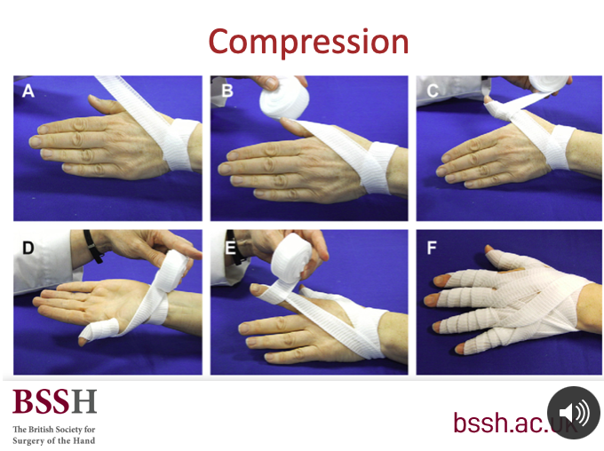 BFIRSTraining's tweet photo. Deb Stanton
#handtherapy #handsurgery #OedemaControl @BAHTHandtherapy @zoeclift @BSSHand @HandSociety @asph_hand @N0RHAND @BasingHand
#Handy tricks for #HandFractures
JOIN US NOW for the webinar from @_WACS_Surgeons @BSSHand @BFIRSTraining
https://t.co/mXGtGmkXrS https://t.co/Xc1jjxj8AL