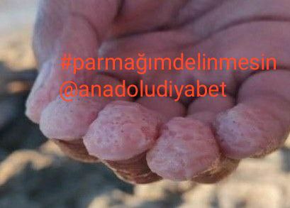 Çaresizliğin adıdır.  ( Tip 1  diyabet)   #parmağımdelinmesin 
<a href="/anadoludiyabet/">🇹🇷🇹🇷ANADOLUDİYABET🇹🇷🇹🇷ADANA</a>
<a href="/RTErdogan/">Recep Tayyip Erdoğan</a>
<a href="/HBTurkoglu/">Hacı Bayram TÜRKOĞLU</a>
<a href="/drfahrettinkoca/">Dr. Fahrettin Koca</a>
<a href="/seferaycan/">Prof. Dr. Sefer Aycan</a>
<a href="/seydayildiz01/">S. Yıldız</a>
<a href="/sgksosyalmedya/">SGK</a>,,
<a href="/deryayanikashb/">Derya Yanık</a>,,,