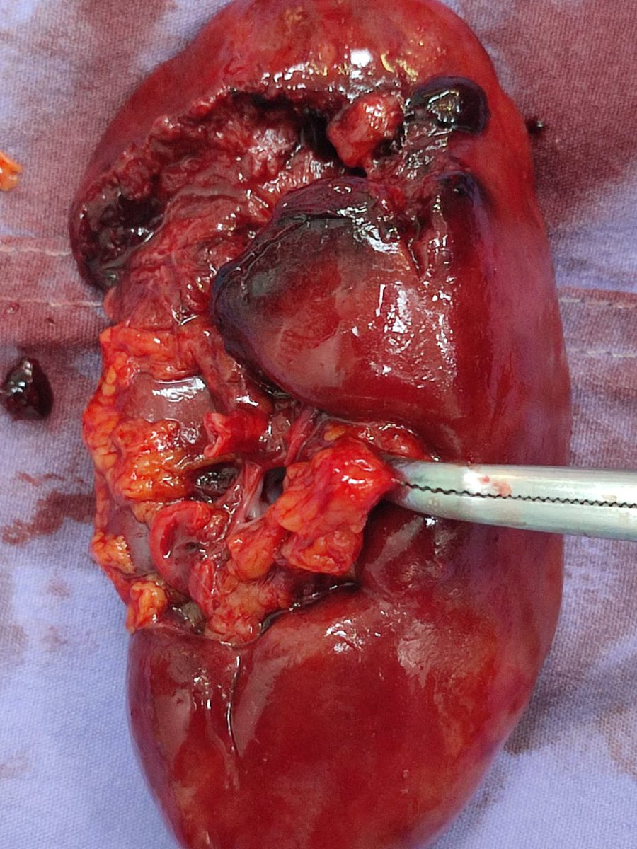 ivan_partidazo's tweet photo. Lesion en primera porción del duodeno subpilorica + lesión renal traumatica grado IV
Secundaria a herida por arma de fuego.
#surgery #Hpaf #trauma https://t.co/TkjizKhXJw