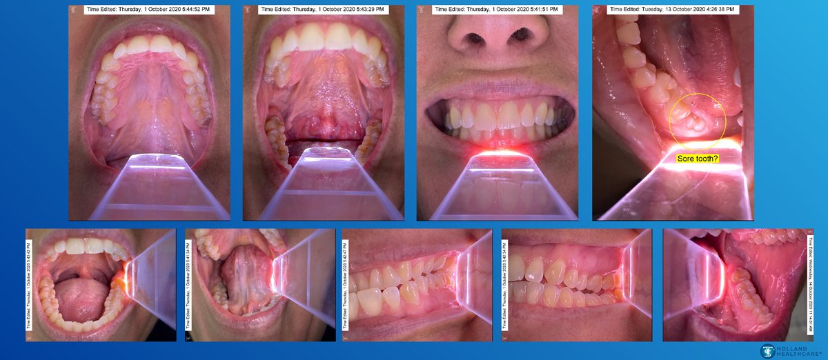 hollandhealth_'s tweet photo. How do you capture #teledentistry photos like this with your iPhone?!
Schedule your free, live demo of TelScope Telehealth System now: https://t.co/t3rwonHGeG
#oralhealth #dentistry #virtualdentistry #pediatricdentistry #telscopetelehealthsystem #intraoralcamera https://t.co/DiUIYXp97S