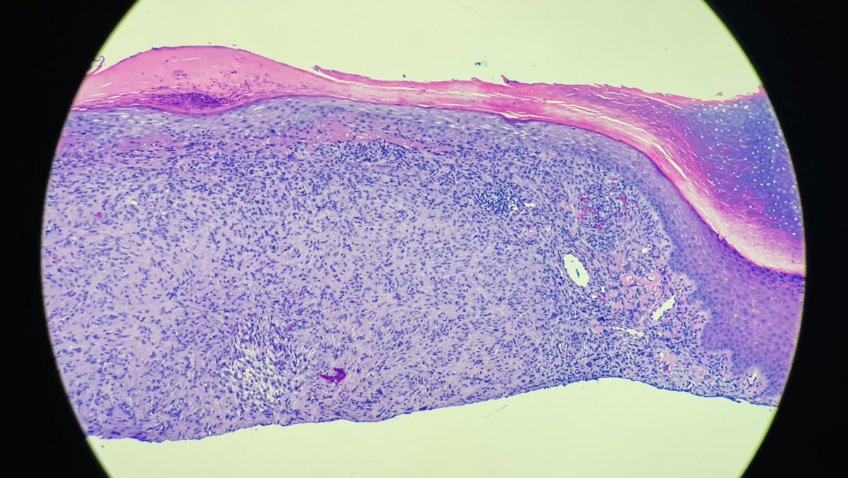 david_terrano's tweet photo. I continue to learn about the past discovered by #dermpaths by morphology alone. Props to @mccalmo again. 

Dr. Cruz, circa…1986!!! Palisaded Fibrous Histiocytoma (Palisaded DF). 

https://t.co/5N4Gyg0zVc

Longer series of DF variants also here: 

https://t.co/VTGLz3cqYW https://t.co/x1hTWiVVZG