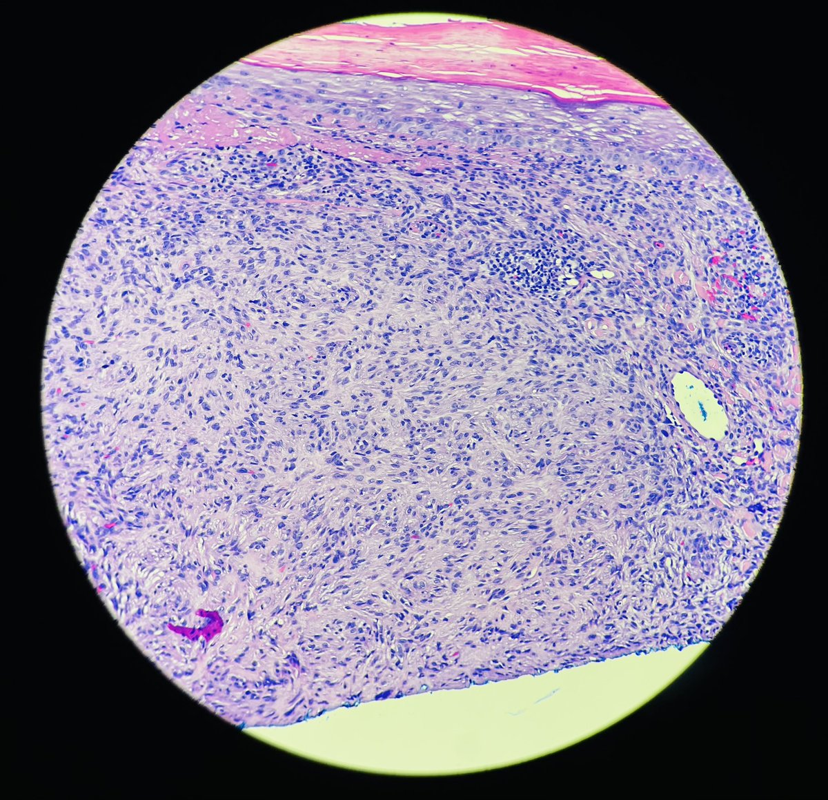 david_terrano's tweet photo. I continue to learn about the past discovered by #dermpaths by morphology alone. Props to @mccalmo again. 

Dr. Cruz, circa…1986!!! Palisaded Fibrous Histiocytoma (Palisaded DF). 

https://t.co/5N4Gyg0zVc

Longer series of DF variants also here: 

https://t.co/VTGLz3cqYW https://t.co/x1hTWiVVZG