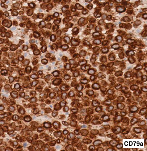 SibaElHussein's tweet photo. #LessonsfromtheFridayUnknowns A case of gray zone lymphoma shown to us by @ljmedeirosMD during #LJMFridayUnknowns ➡️ https://t.co/nFMhlopBwi #hemepath #pathtwitter #lymsm @Dowhankim @KirillLyapichev @SkybhatiaMD @Xiaoqiong_Wang @LianqunQiu @hemepathguy @RMirandaMD https://t.co/Y352DcvhFf