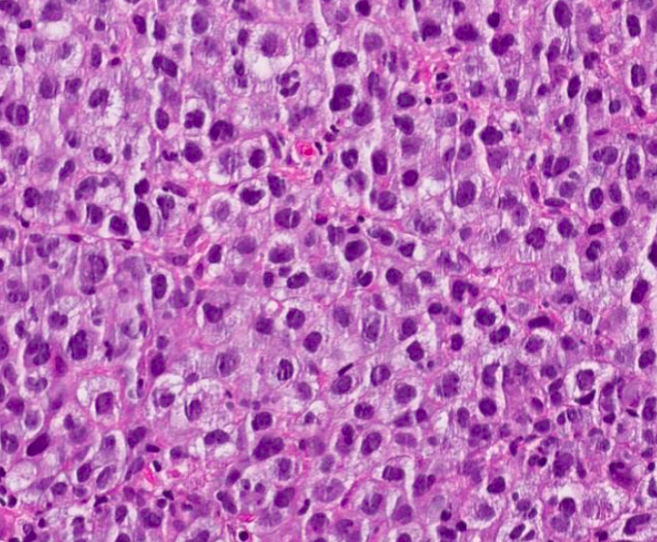 SibaElHussein's tweet photo. #LessonsfromtheFridayUnknowns A case of gray zone lymphoma shown to us by @ljmedeirosMD during #LJMFridayUnknowns ➡️ https://t.co/nFMhlopBwi #hemepath #pathtwitter #lymsm @Dowhankim @KirillLyapichev @SkybhatiaMD @Xiaoqiong_Wang @LianqunQiu @hemepathguy @RMirandaMD https://t.co/Y352DcvhFf
