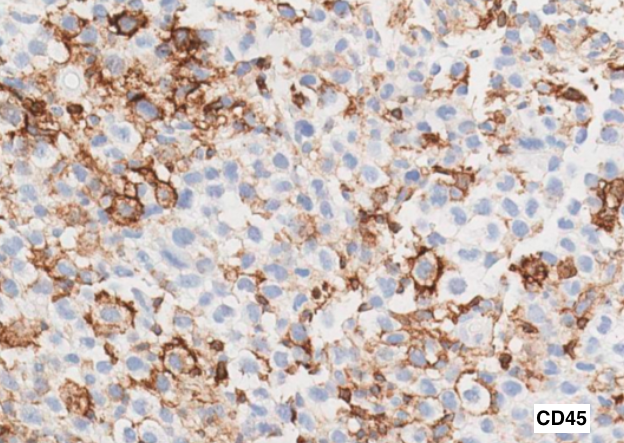 SibaElHussein's tweet photo. #LessonsfromtheFridayUnknowns A case of gray zone lymphoma shown to us by @ljmedeirosMD during #LJMFridayUnknowns ➡️ https://t.co/nFMhlopBwi #hemepath #pathtwitter #lymsm @Dowhankim @KirillLyapichev @SkybhatiaMD @Xiaoqiong_Wang @LianqunQiu @hemepathguy @RMirandaMD https://t.co/Y352DcvhFf