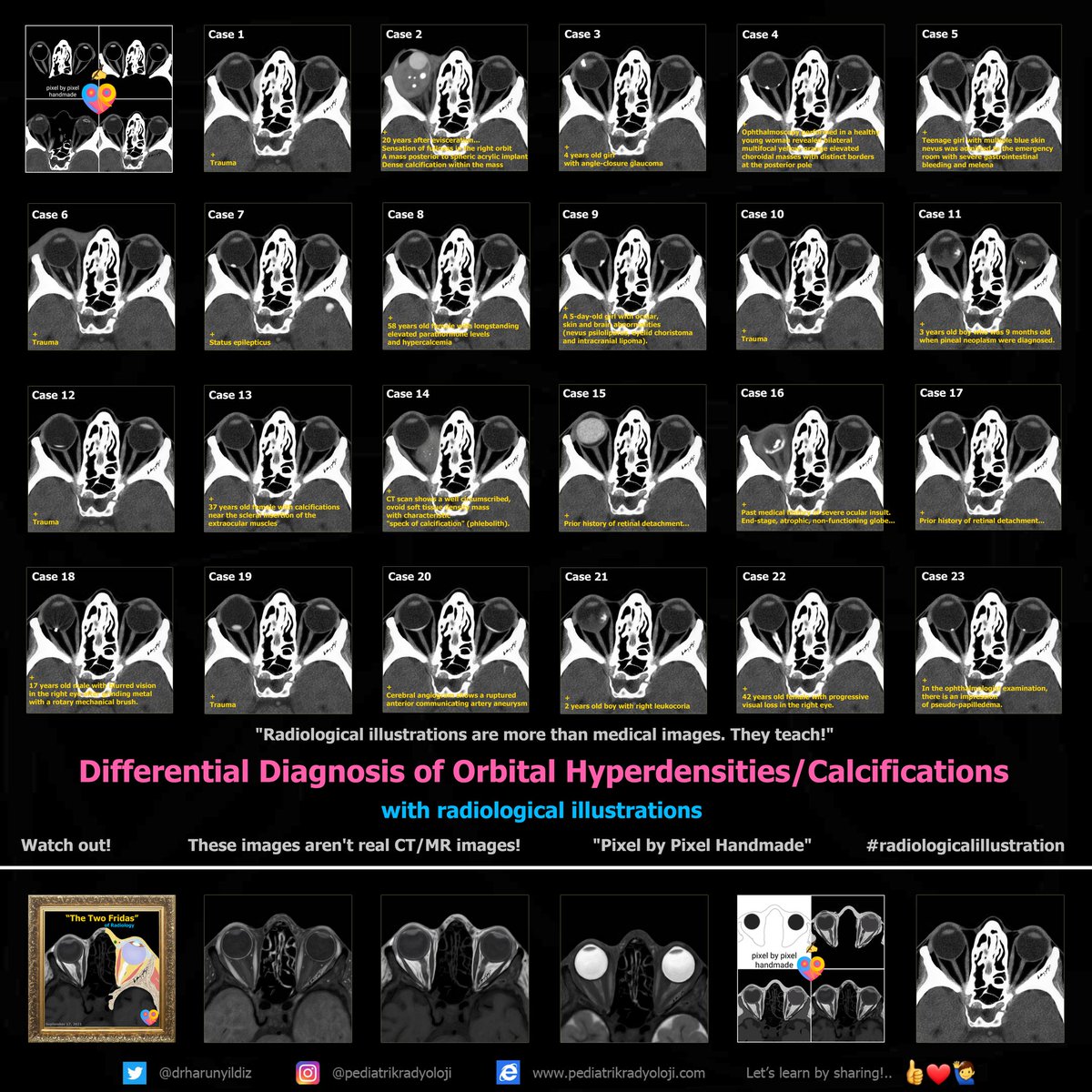 1/4
Differential Diagnosis of Orbital Hyperdensities 

Watch out!
These images aren't real CT/MR images! 😇 
"Pixel by Pixel Handmade" ✍ 

<a href="/ASHNRSociety/">ASHNR</a> <a href="/ESHNRSociety/">ESHNR</a> <a href="/BSHNI_UK/">British Society of Head & Neck Imaging</a> <a href="/cookyscan1/">Cooky Menias</a> <a href="/Dshatzkes/">Deborah Shatzkes</a> <a href="/PhilipRChapman1/">Philip R. Chapman, MD</a> <a href="/RyanBPetersonMD/">Ryan B Peterson 🇸🇪</a> <a href="/JudyGadde/">Judy Gadde, DO, MBA</a> <a href="/tabby_kennedy/">Tabby A. Kennedy, MD</a> <a href="/jannimd/">Jannette Collins, MD, MEd, FACR</a>
⤵️