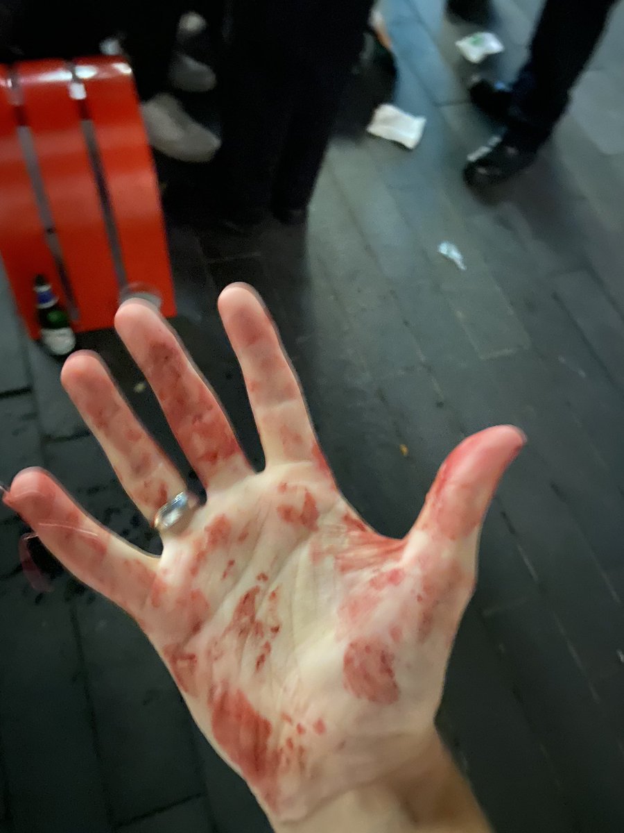 olivxr's tweet photo. (content/trigger warning)
so last night my worst possible fear came true and on the way home from a date, we were attacked unprovoked whilst crossing charing cross bridge by a fairly large group of people to the point of needing a night in hospital. https://t.co/twq2AGQ9dp