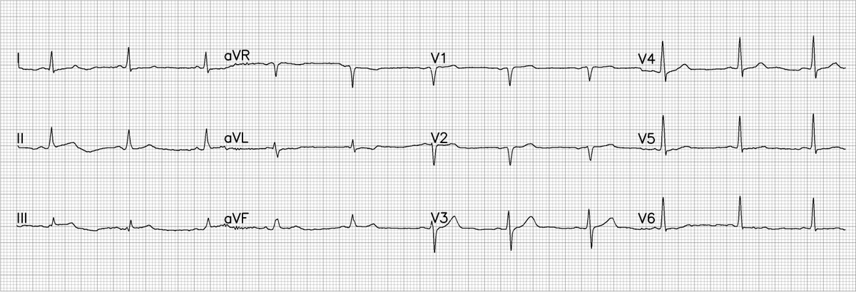 tbouthillet's tweet photo. 53 year old male with chest discomfort. Computerized interpretive statement reads normal. Do you have any concerns? https://t.co/9HAP7j0JMB