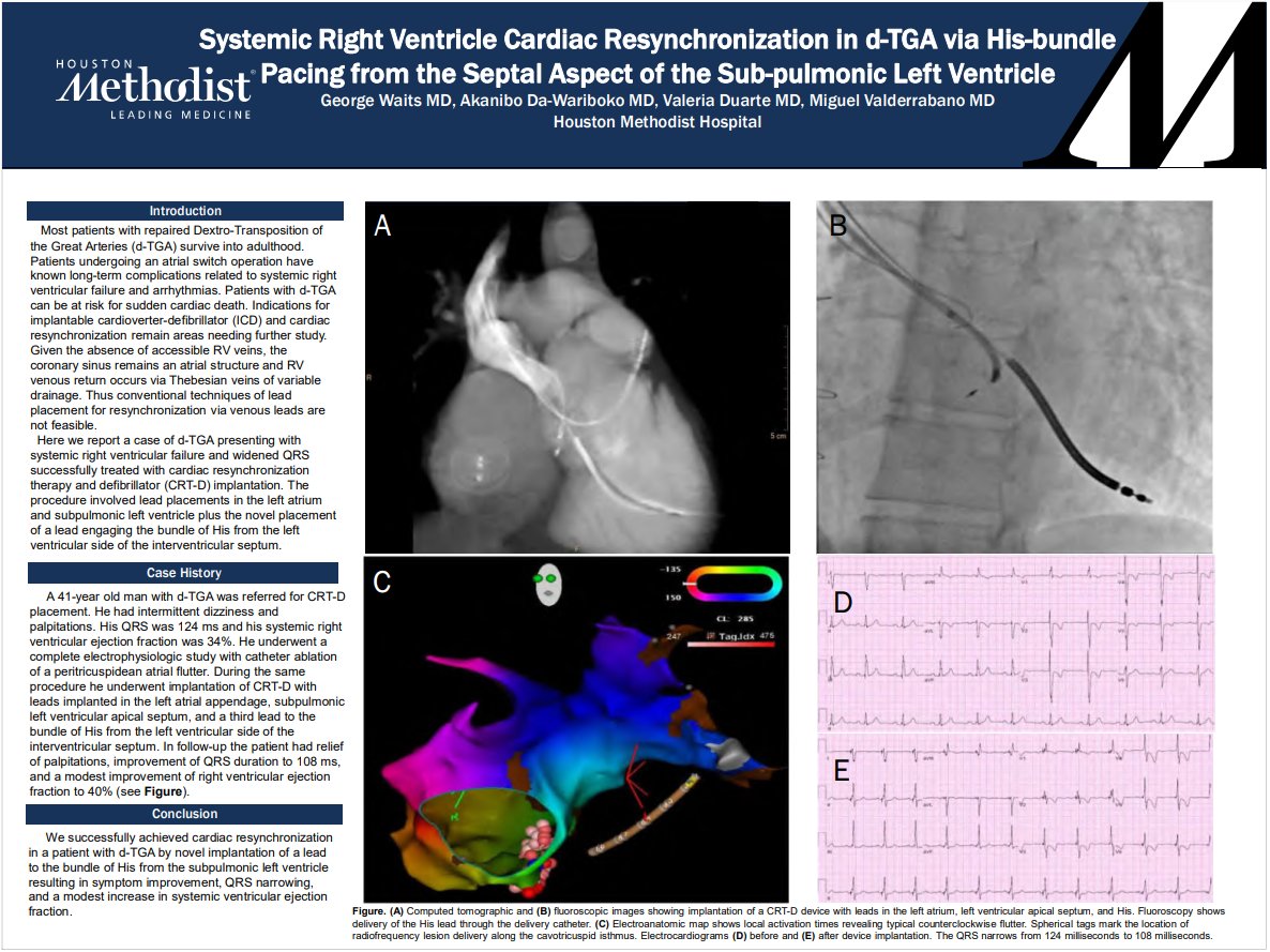 Joe Aoun (@joe_aoun_) on Twitter photo Congrats to <a href="/Georgetweet4/">George Waits</a> on winning in the #TCACC2021 abstract competition. A case of cardiac resynchronization therapy in d-TGA <a href="/HMHCardioFellow/">Houston Methodist Cardiovascular Fellowships</a> <a href="/FeelingThePulse/">Akanibo Da-Wariboko, MD</a> @MiguelVldrbno <a href="/SLittleMD/">Stephen Little, MD</a> Congrats to <a href="/Georgetweet4/">George Waits</a> on winning in the #TCACC2021 abstract competition. A case of cardiac resynchronization therapy in d-TGA <a href="/HMHCardioFellow/">Houston Methodist Cardiovascular Fellowships</a> <a href="/FeelingThePulse/">Akanibo Da-Wariboko, MD</a> @MiguelVldrbno <a href="/SLittleMD/">Stephen Little, MD</a>