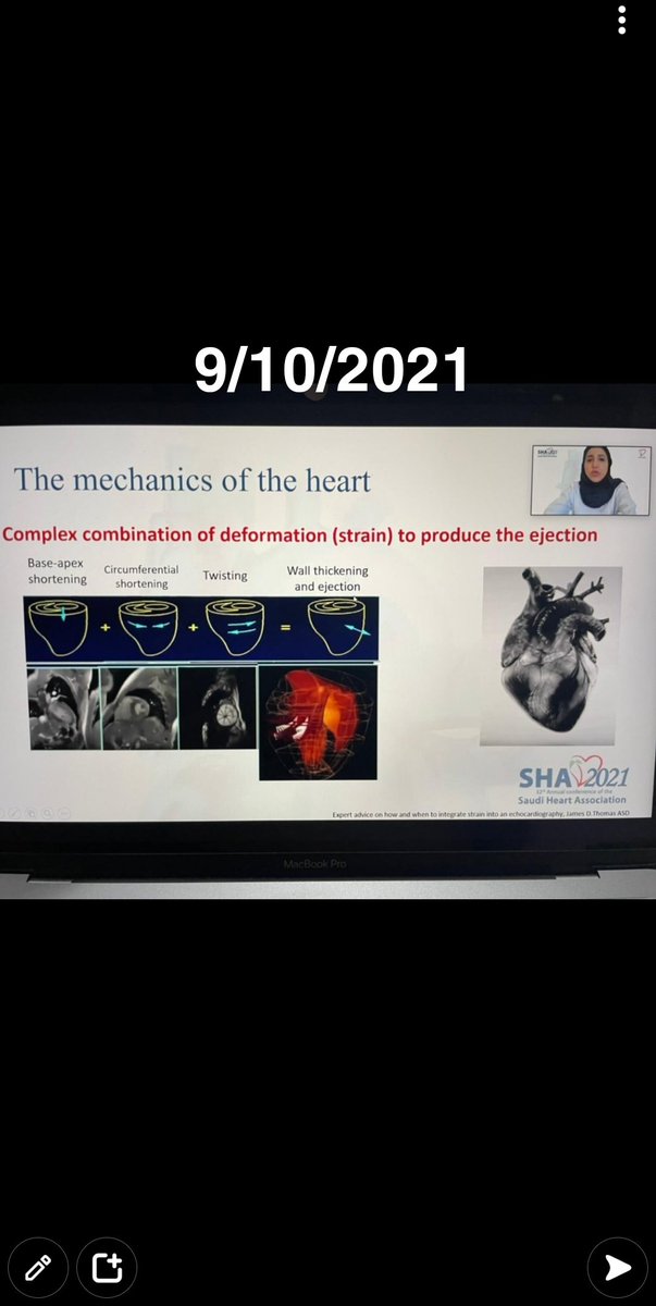 EchoCases_MB's tweet image. My participation in SHA21, How to Perform Speckle Tracking :STEP by Step Approach.
#SHA21