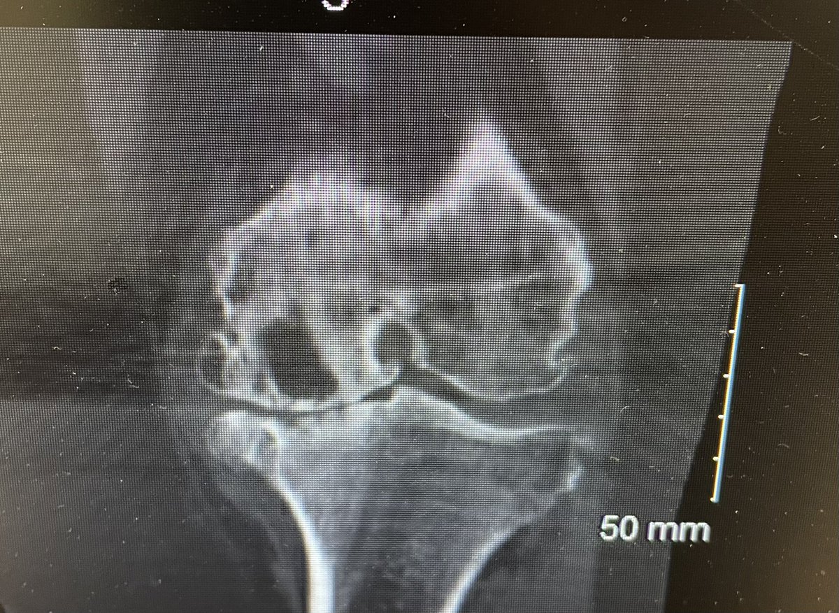 jan_gebbertMD's tweet photo. Arthroplasty #ortho friends. 
Large MFC cyst. Given that it will be a contained defect. 
-Augment/stem
-Bone graft/cement/stem 
- Cement defect/stem. 
@kneedoclond @kneeguyuk @generalorthomd https://t.co/AHSszis3Oh