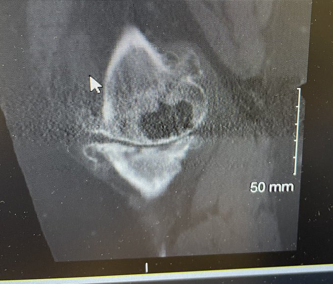 jan_gebbertMD's tweet photo. Arthroplasty #ortho friends. 
Large MFC cyst. Given that it will be a contained defect. 
-Augment/stem
-Bone graft/cement/stem 
- Cement defect/stem. 
@kneedoclond @kneeguyuk @generalorthomd https://t.co/AHSszis3Oh
