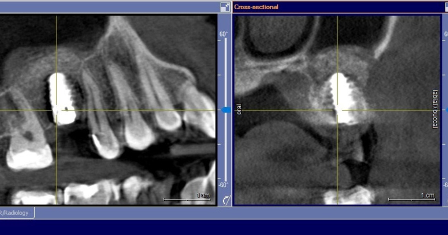 MischInstitute's tweet photo. 2 Weeks after the Texas S4 course, Dr. Jacob Cary from Owasso, OK performed this perfect lateral wall sinus graft. Great Job! https://t.co/P9SvdsOnfB
